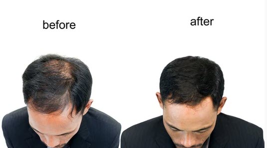 Get Your Hair Back With Stem Cell - Breath